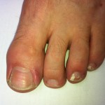 White Plaque like Fungal Nail infection