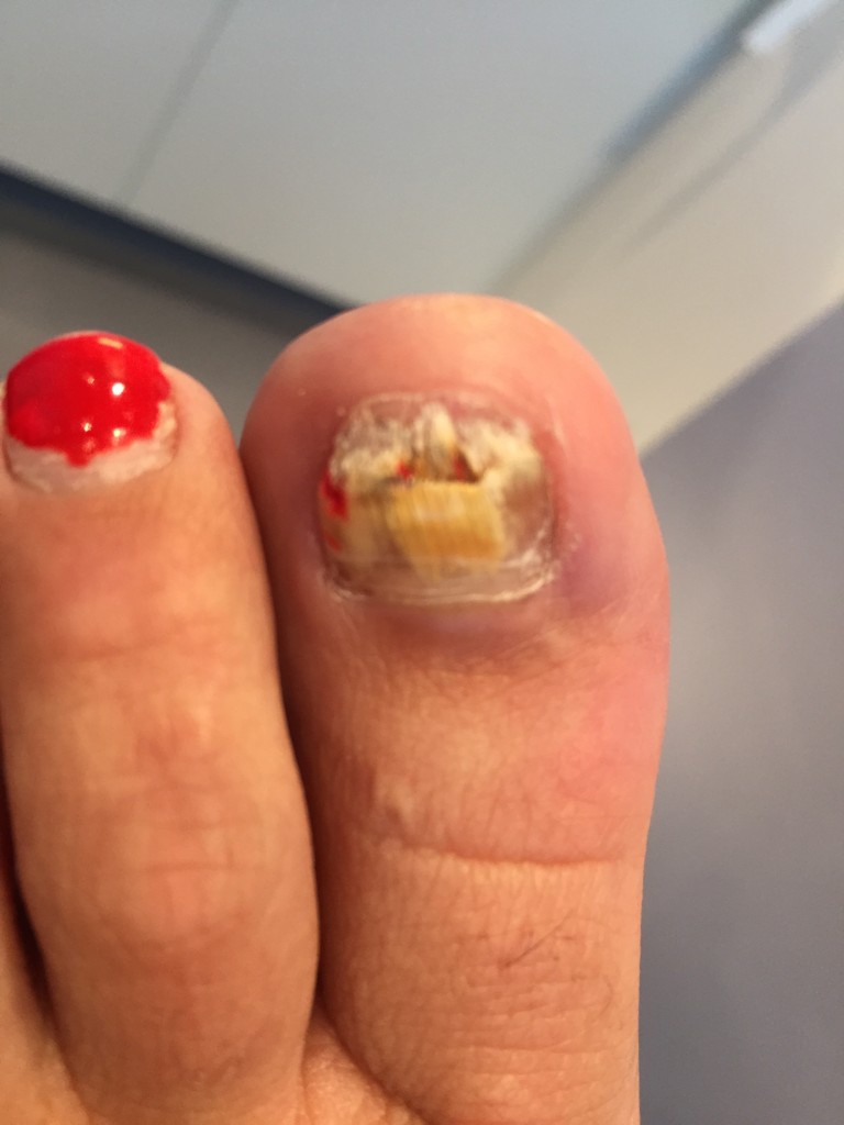 Spring is the time to start your Fungal Nail Treatment Richmond Podiatry